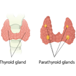 سی تی آنژیوگرافی پاراتیروئید: انقلابی در تشخیص دقیق ضایعات پاراتیروئید
